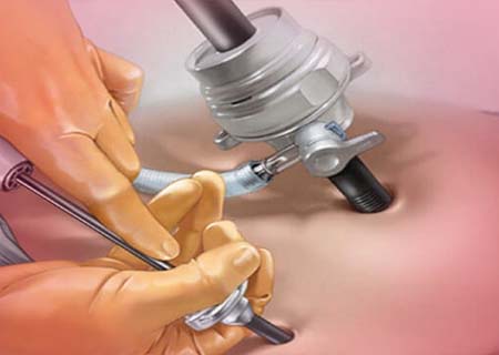 Laproscopy Incision Infected High Risk Pregnancy Specialist in South Delhi | Dr Jaya Agarwal