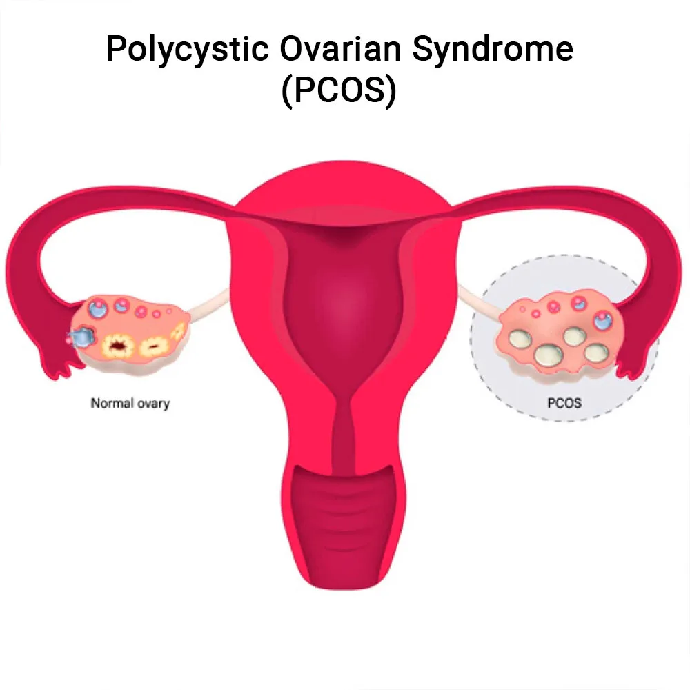 Best Doctor For Pcos